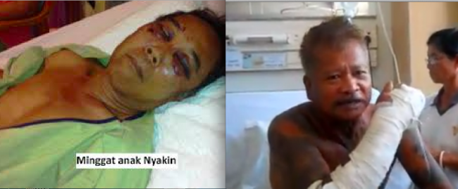 Stand up to the loggers at your peril. Sarawak Report is being criticised for highlighting the plight of native people like Mingat and his son and Surik (right) who were all beaten within an inch of their lives.